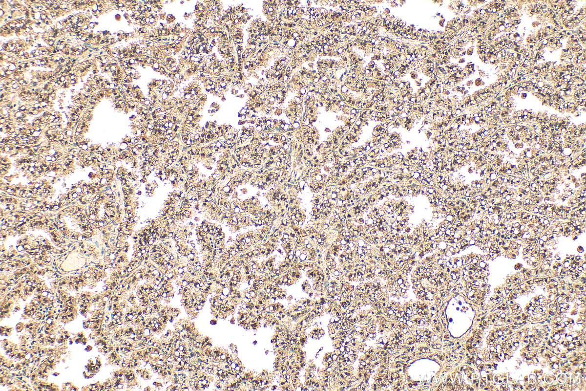 Immunohistochemistry (IHC) staining of human lung cancer tissue using NT5DC1 Polyclonal antibody (24102-1-AP)