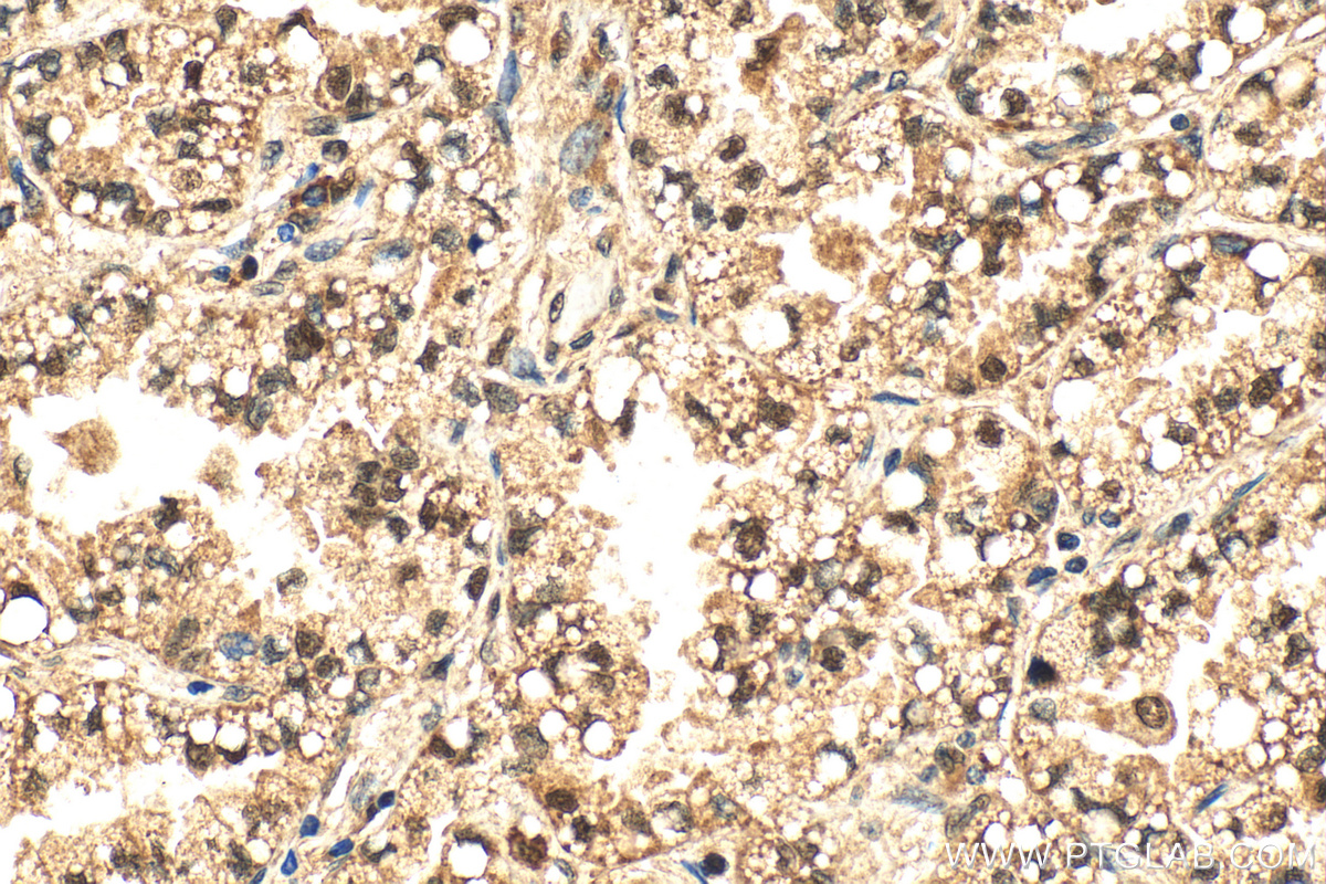 Immunohistochemistry (IHC) staining of human lung cancer tissue using NT5DC1 Polyclonal antibody (24102-1-AP)