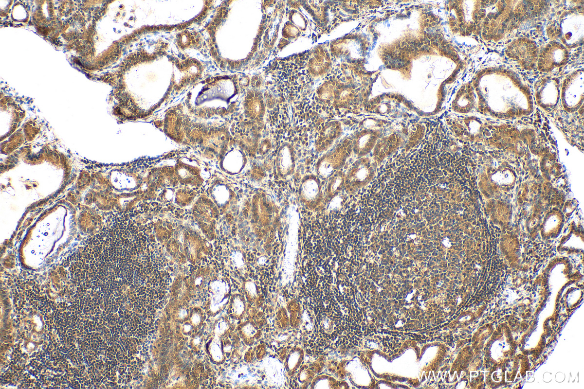 Immunohistochemistry (IHC) staining of human thyroid cancer tissue using NT5DC1 Polyclonal antibody (24102-1-AP)