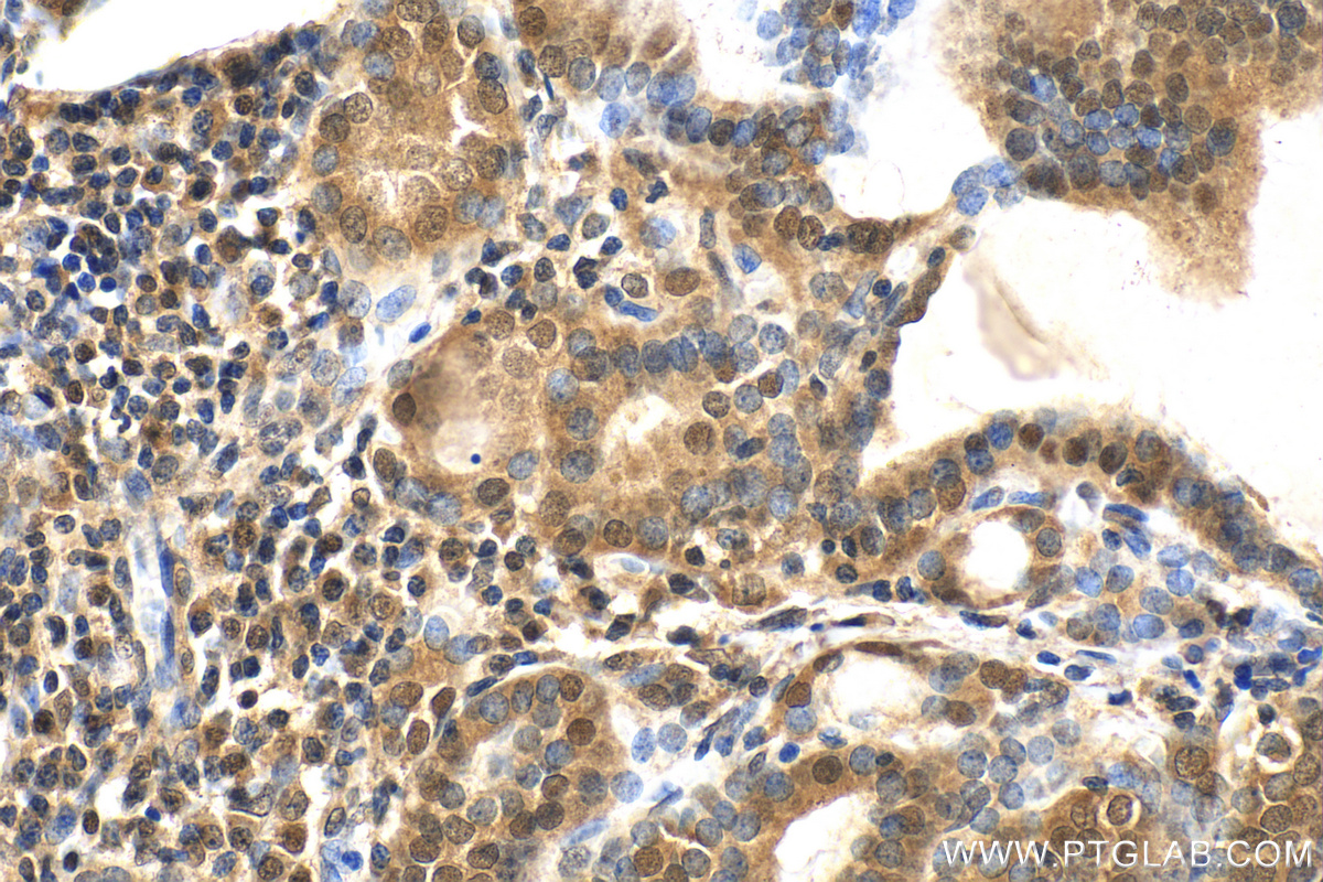 Immunohistochemistry (IHC) staining of human thyroid cancer tissue using NT5DC1 Polyclonal antibody (24102-1-AP)