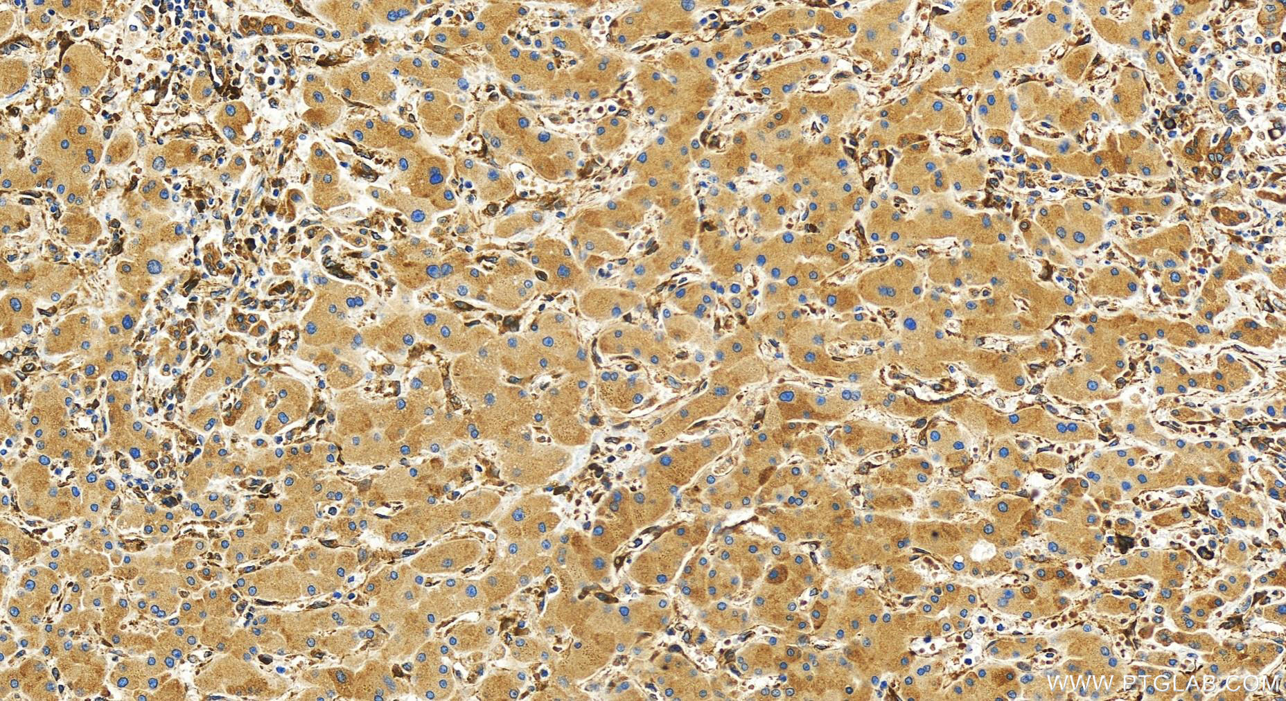 Immunohistochemistry (IHC) staining of human intrahepatic cholangiocarcinoma tissue using NUCB2/nesfatin-1 Polyclonal antibody (30604-1-AP)