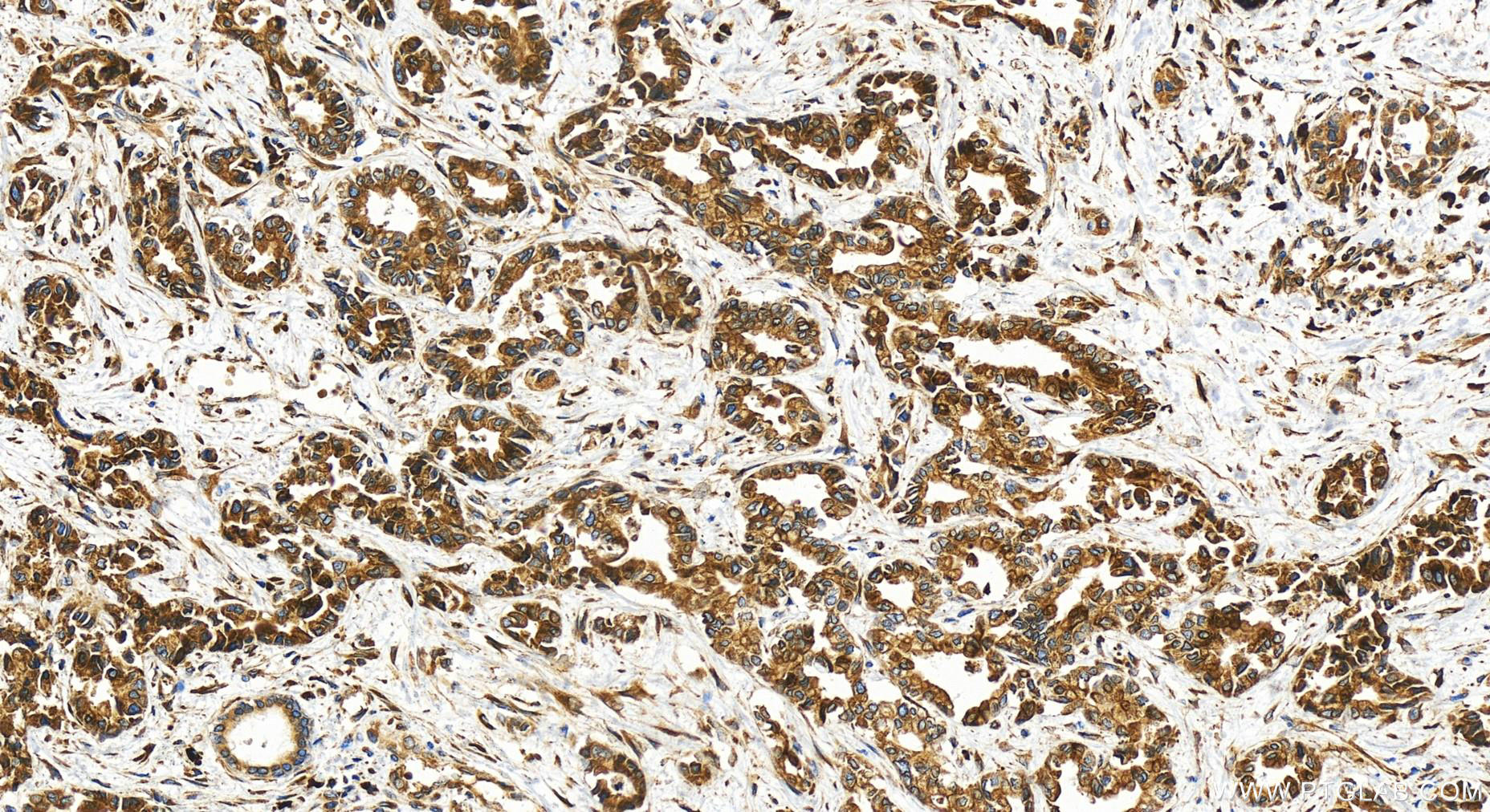 Immunohistochemistry (IHC) staining of human intrahepatic cholangiocarcinoma tissue using NUCB2/nesfatin-1 Polyclonal antibody (30604-1-AP)