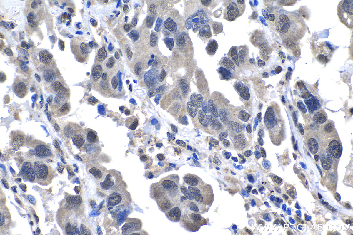 Immunohistochemistry (IHC) staining of human lung cancer tissue using NUP62CL Polyclonal antibody (25381-1-AP)