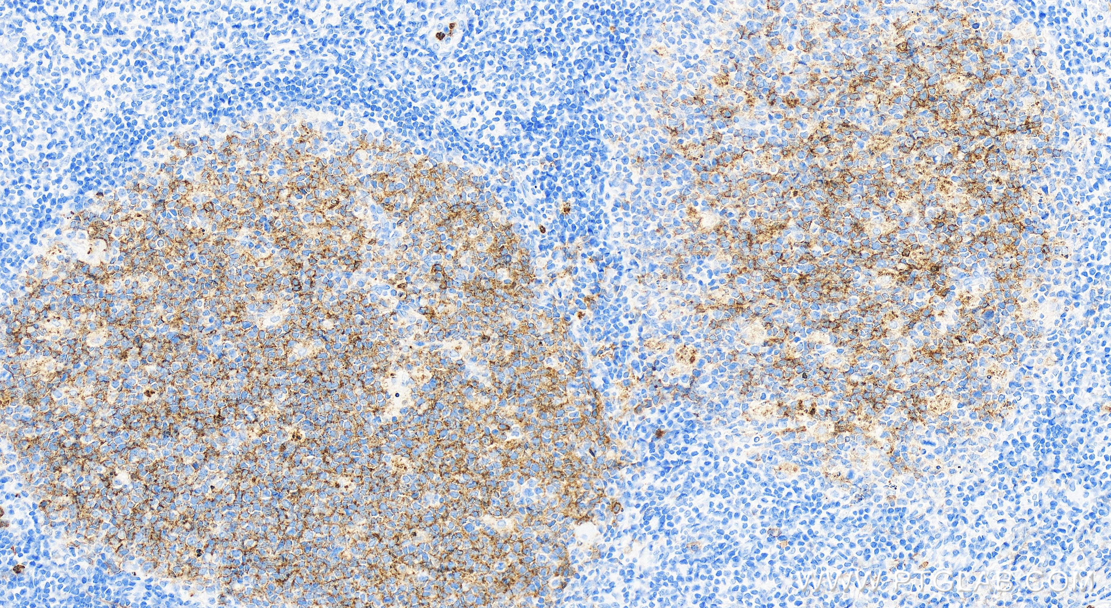 Immunohistochemistry (IHC) staining of human tonsillitis tissue using Neprilysin/CD10 Recombinant antibody (84181-1-RR)