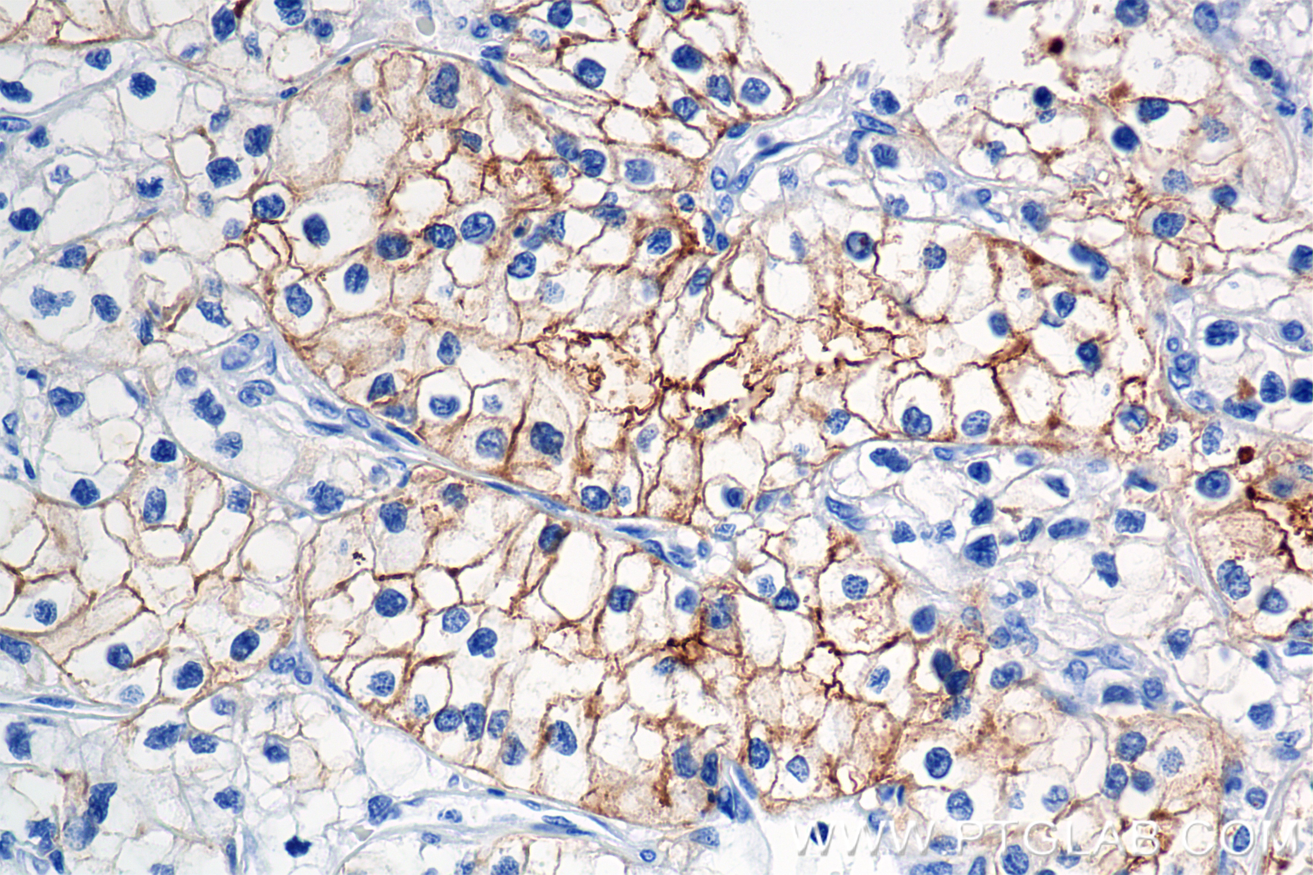 Immunohistochemistry (IHC) staining of Human Kidney(renal cell) Cancer using Neprilysin/CD10 Recombinant antibody (84181-1-RR)