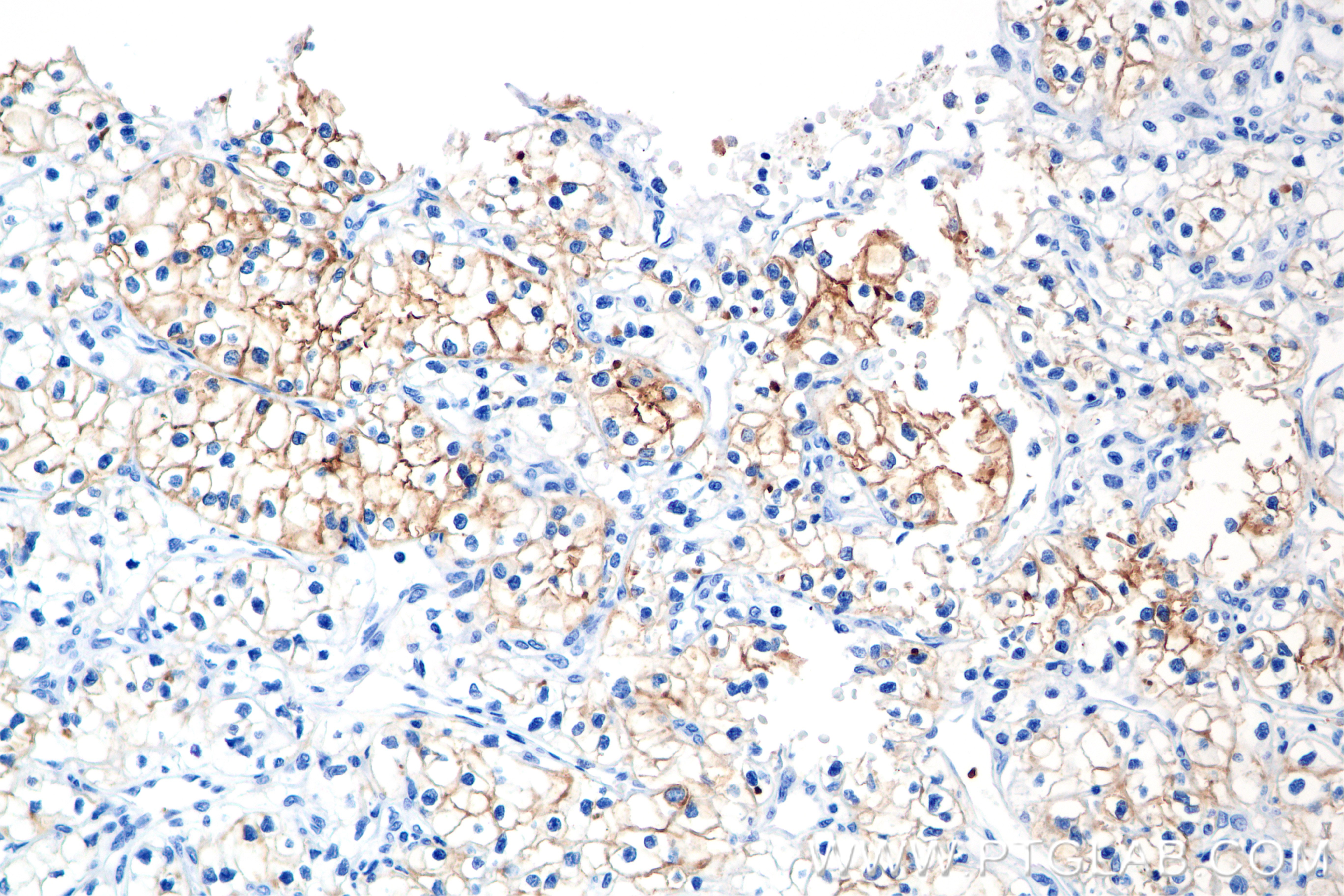 Immunohistochemistry (IHC) staining of Human Kidney(renal cell) Cancer using Neprilysin/CD10 Recombinant antibody (84181-1-RR)