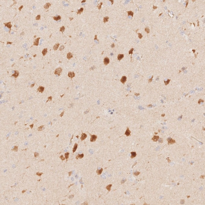 Immunohistochemistry (IHC) staining of human gliomas tissue using NeuN Monoclonal antibody (66836-1-Ig)