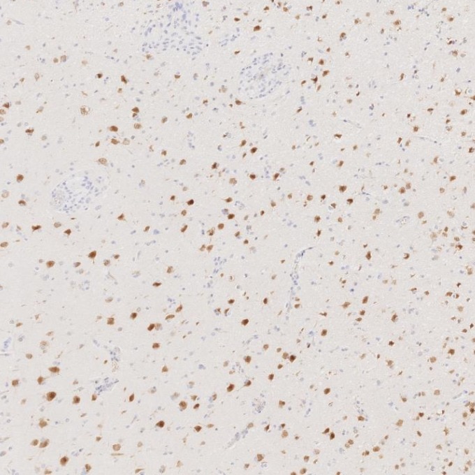 Immunohistochemistry (IHC) staining of human gliomas tissue using NeuN Monoclonal antibody (66836-1-Ig)