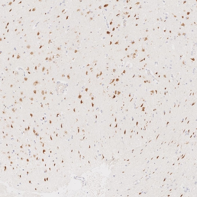 Immunohistochemistry (IHC) staining of human gliomas tissue using NeuN Monoclonal antibody (66836-1-Ig)