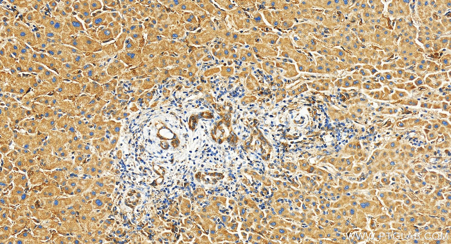 Immunohistochemistry (IHC) staining of human intrahepatic cholangiocarcinoma tissue using Neuropilin 2 Polyclonal antibody (27193-1-AP)