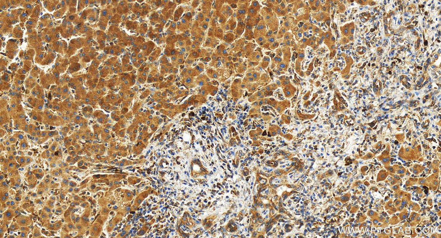 Immunohistochemistry (IHC) staining of human intrahepatic cholangiocarcinoma tissue using NUCB2/nesfatin-1 Polyclonal antibody (26712-1-AP)