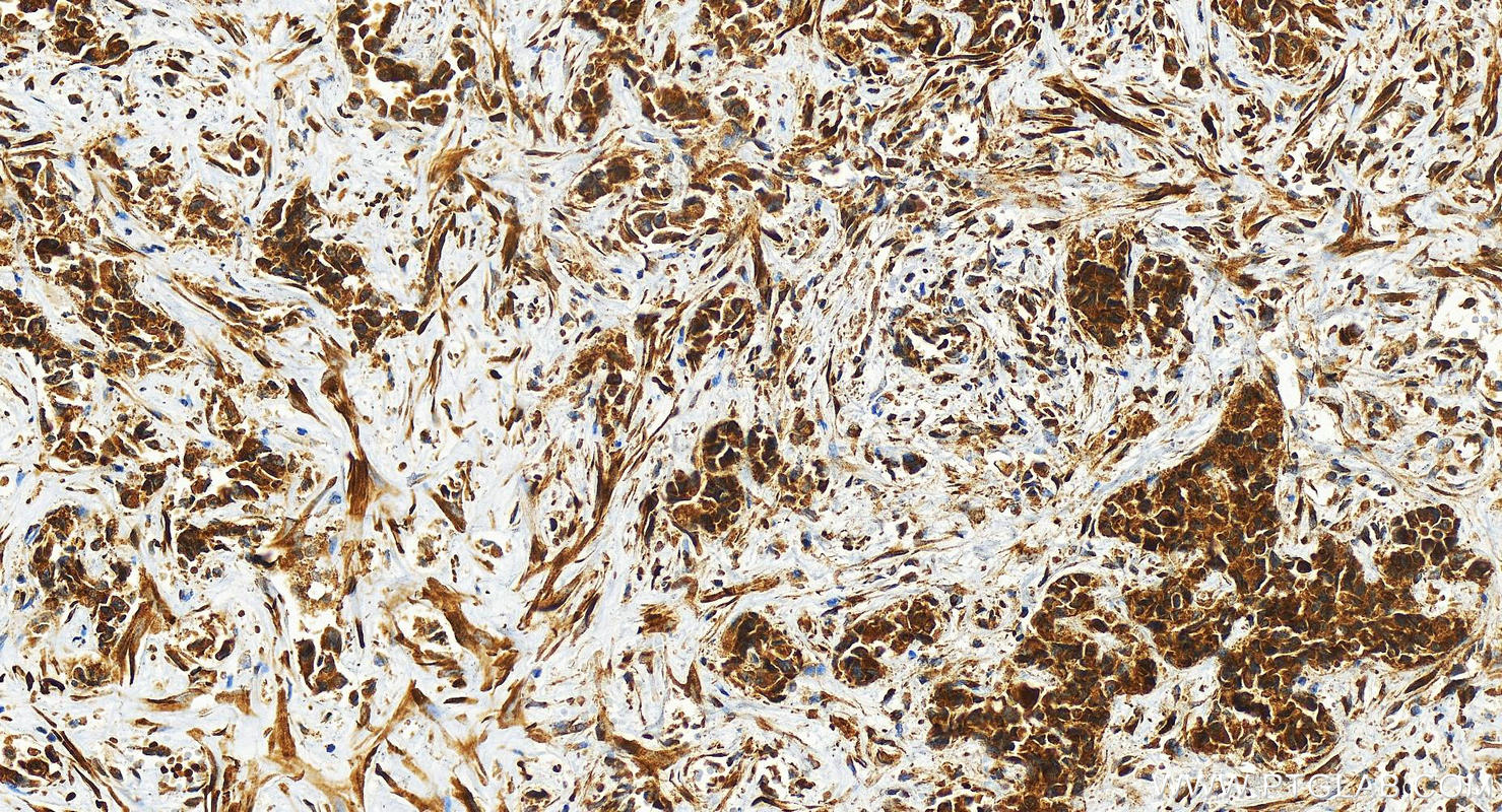 Immunohistochemistry (IHC) staining of human intrahepatic cholangiocarcinoma tissue using NUCB2/nesfatin-1 Polyclonal antibody (26712-1-AP)