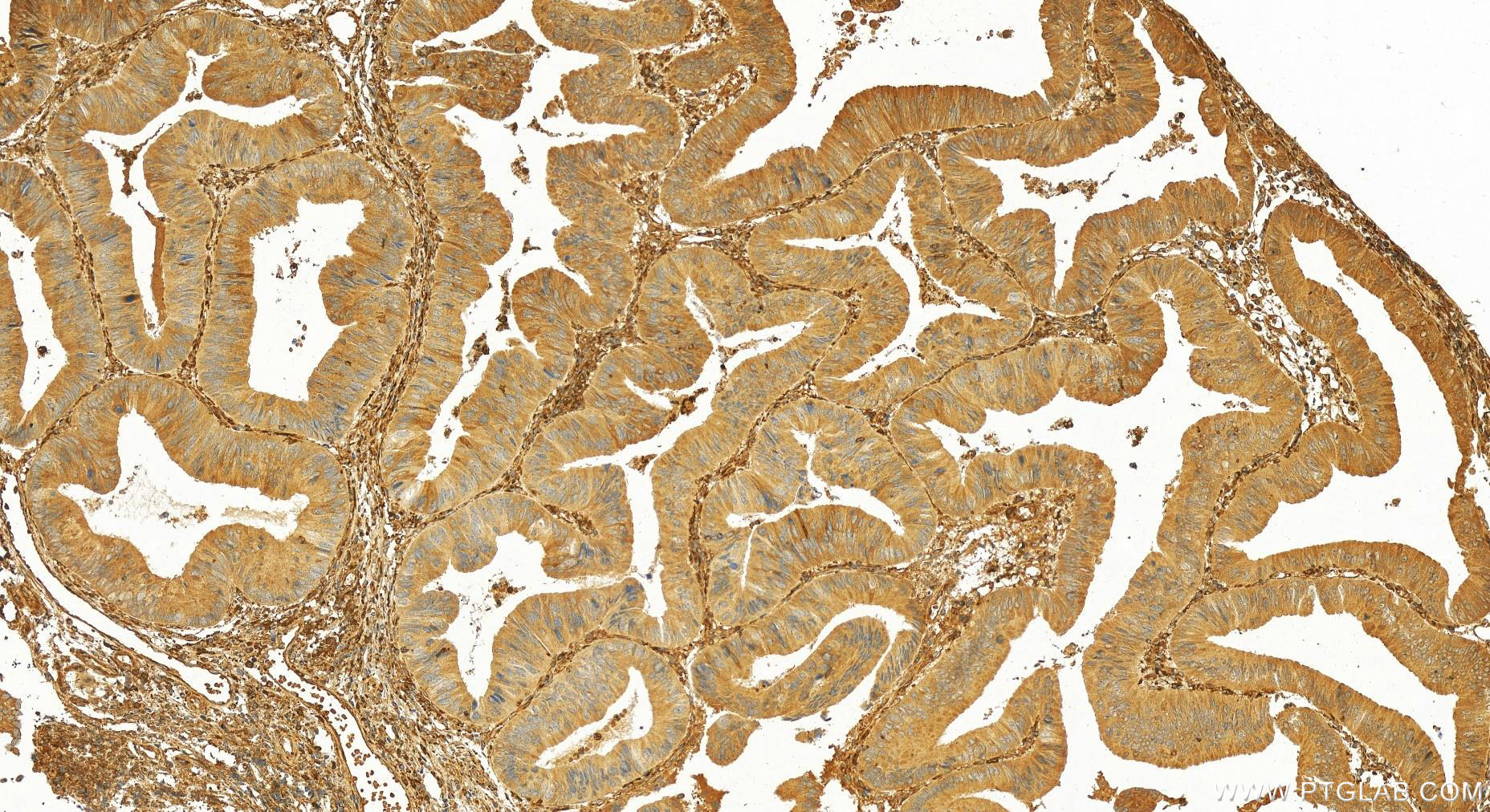 Immunohistochemistry (IHC) staining of human colon  cancer using OAS2 Polyclonal antibody (19279-1-AP)