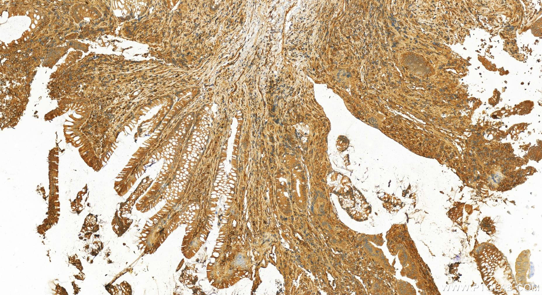 Immunohistochemistry (IHC) staining of human colon  cancer using OAS2 Polyclonal antibody (19279-1-AP)