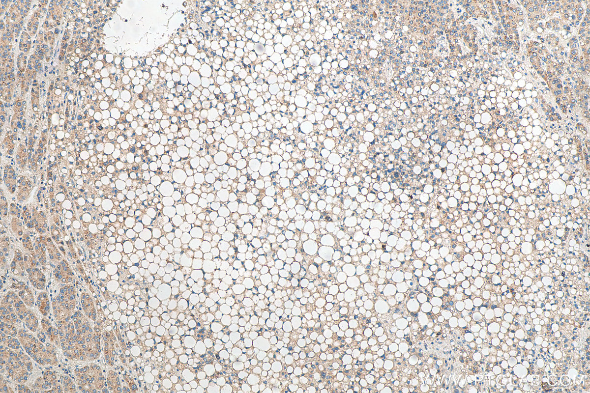 Immunohistochemistry (IHC) staining of human liver cancer tissue using OAS2 Polyclonal antibody (19279-1-AP)