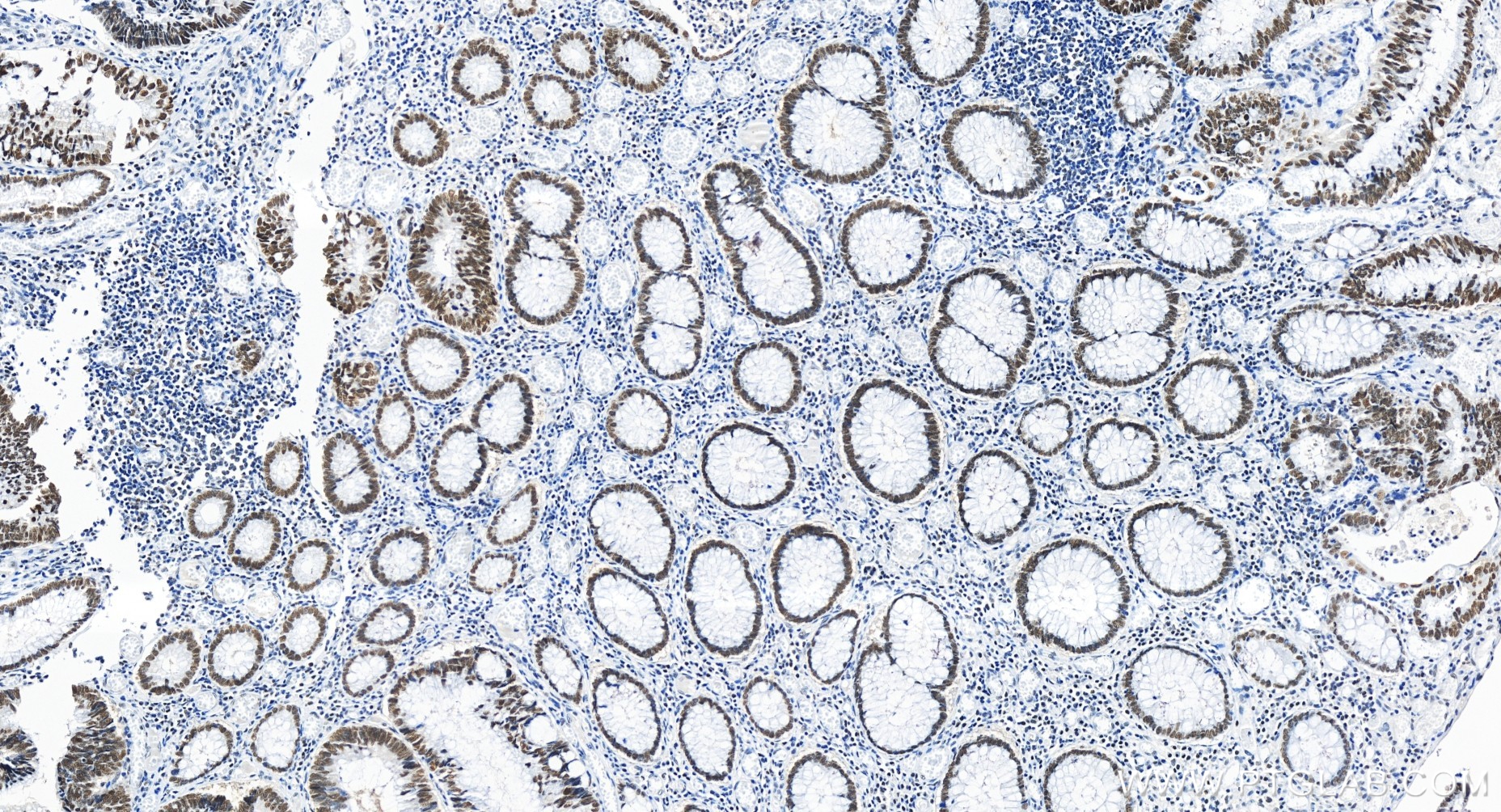 Immunohistochemistry (IHC) staining of human colon cancer tissue using OCT1 Recombinant antibody (85726-1-RR)