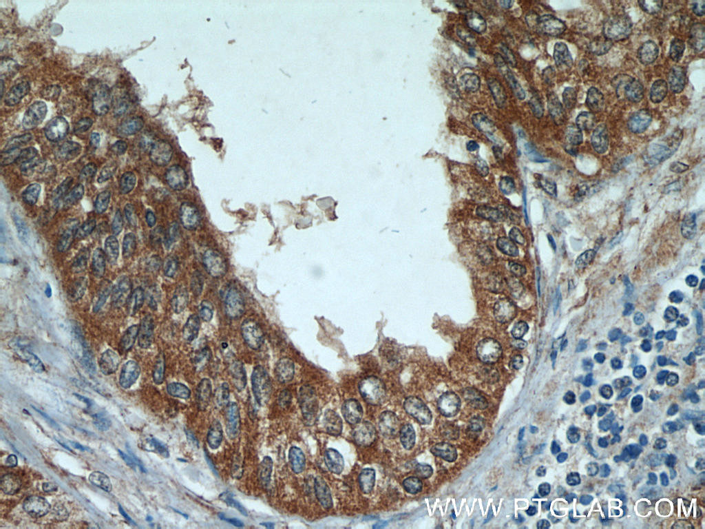 Immunohistochemistry (IHC) staining of human prostate hyperplasia tissue using ODC1 Polyclonal antibody (23454-1-AP)