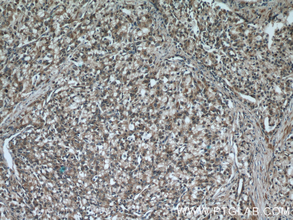 Immunohistochemistry (IHC) staining of human prostate cancer tissue using ODC1 Polyclonal antibody (23454-1-AP)