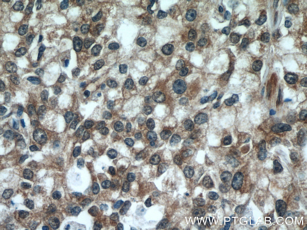 Immunohistochemistry (IHC) staining of human prostate cancer tissue using ODC1 Polyclonal antibody (23454-1-AP)