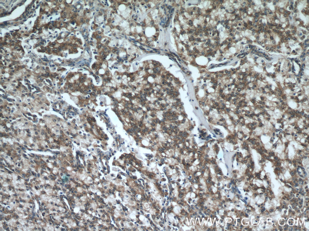 Immunohistochemistry (IHC) staining of human prostate cancer tissue using ODC1 Polyclonal antibody (23454-1-AP)