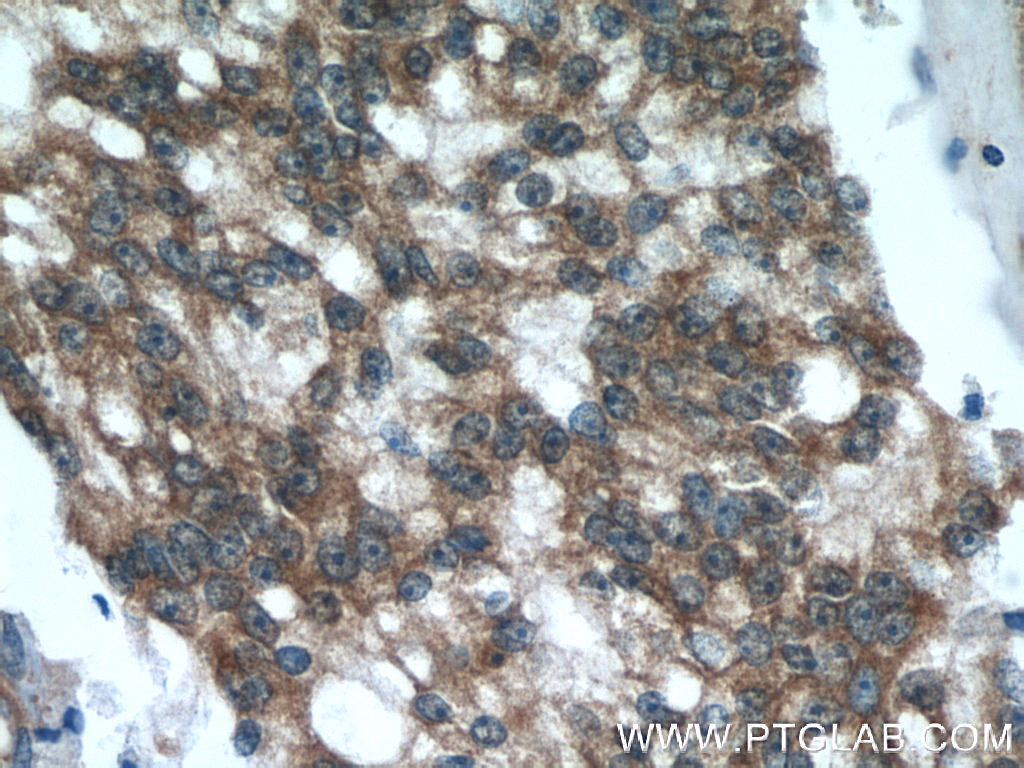 Immunohistochemistry (IHC) staining of human prostate cancer tissue using ODC1 Polyclonal antibody (23454-1-AP)