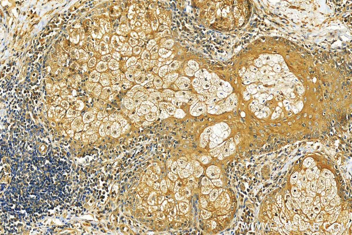 Immunohistochemistry (IHC) staining of human skin cancer tissue using ODC1 Polyclonal antibody (28728-1-AP)