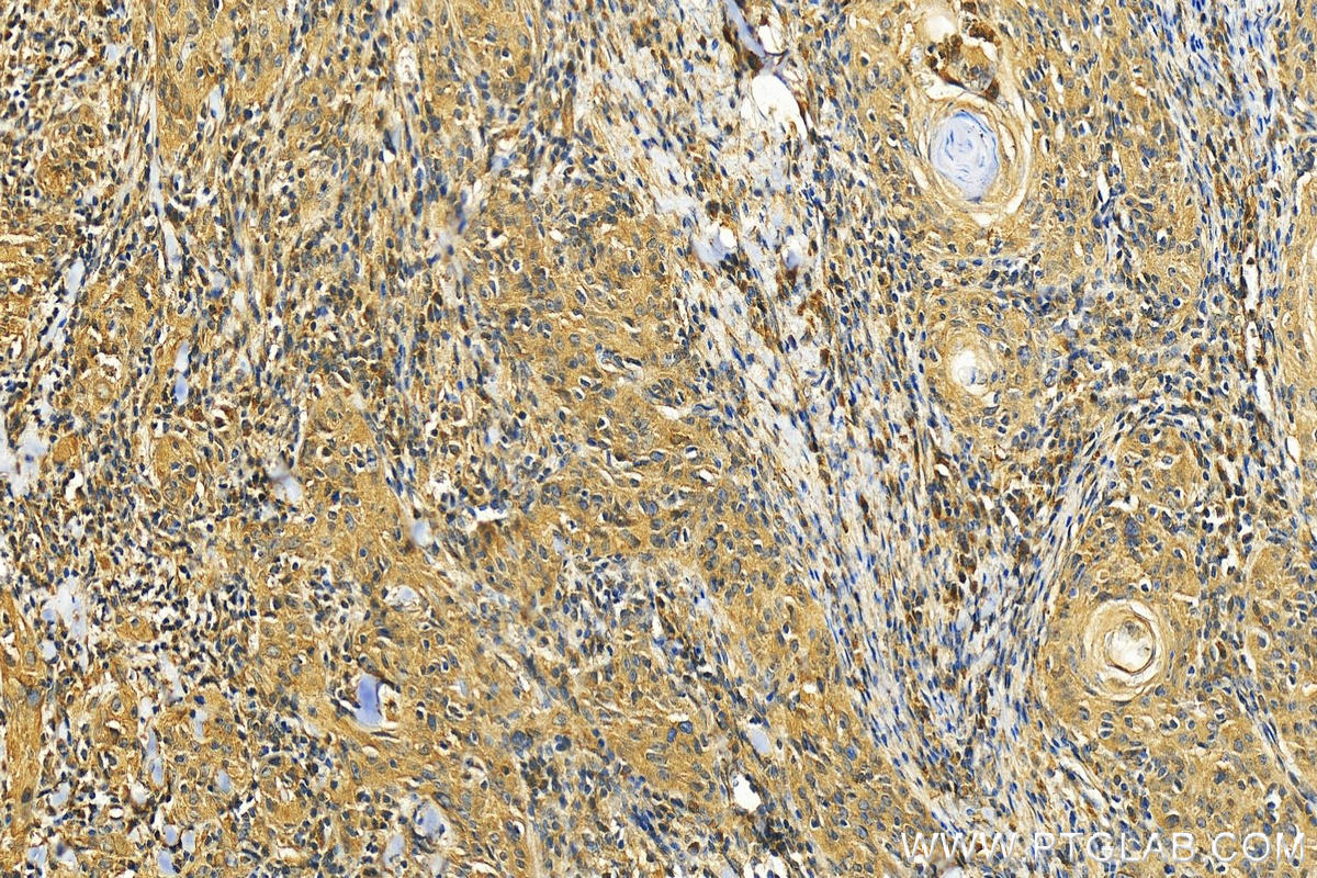 Immunohistochemistry (IHC) staining of human skin cancer tissue using ODC1 Polyclonal antibody (28728-1-AP)