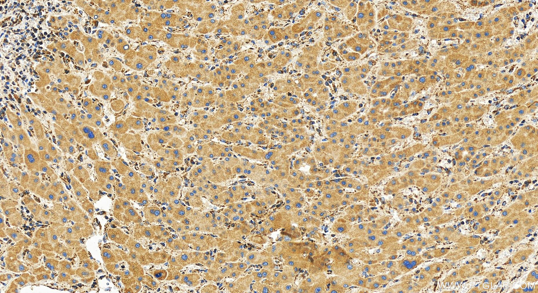 Immunohistochemistry (IHC) staining of human intrahepatic cholangiocarcinoma tissue using OGDH Recombinant antibody (82773-1-RR)