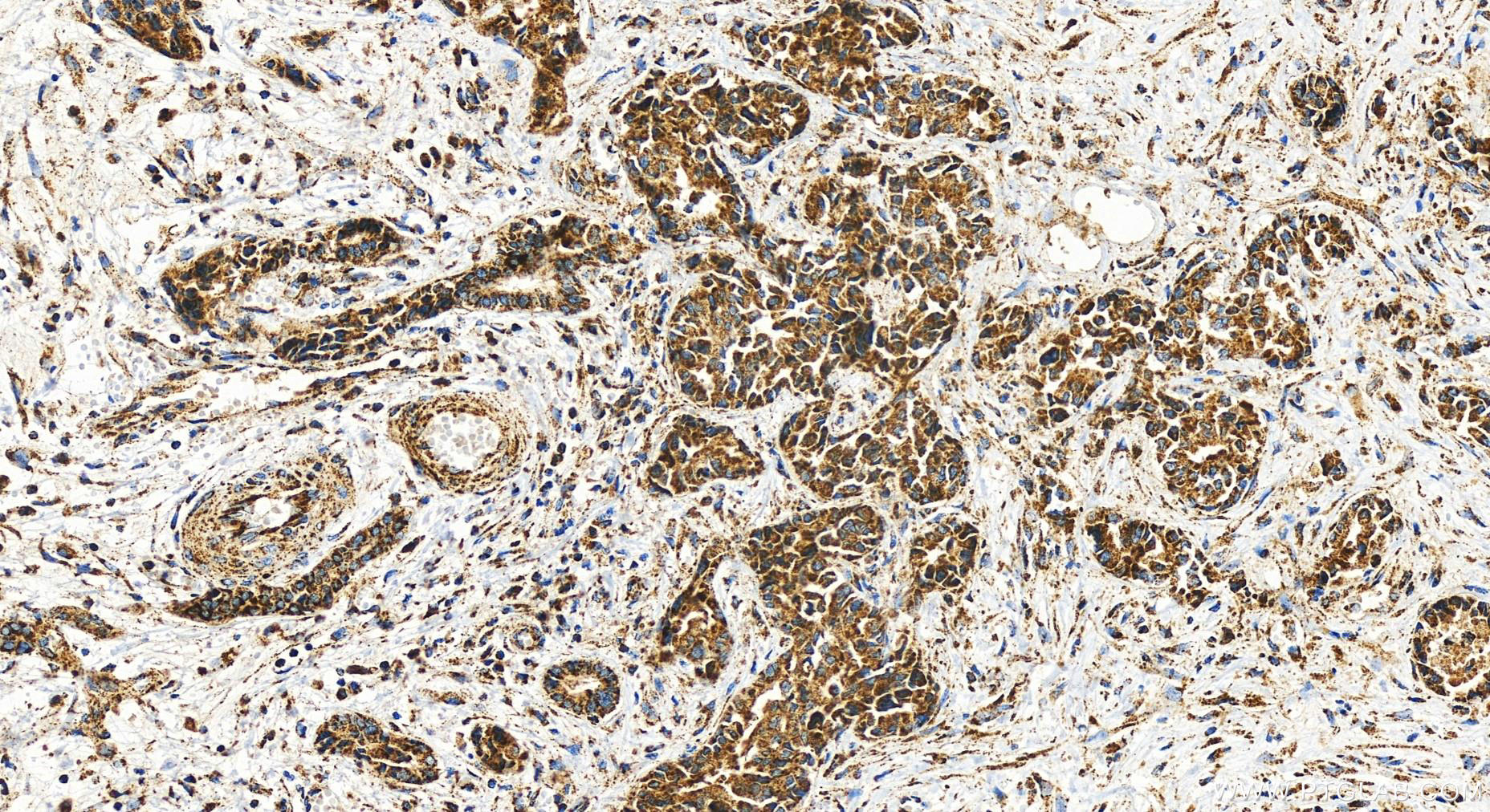 Immunohistochemistry (IHC) staining of human intrahepatic cholangiocarcinoma tissue using OGDH Recombinant antibody (82773-1-RR)