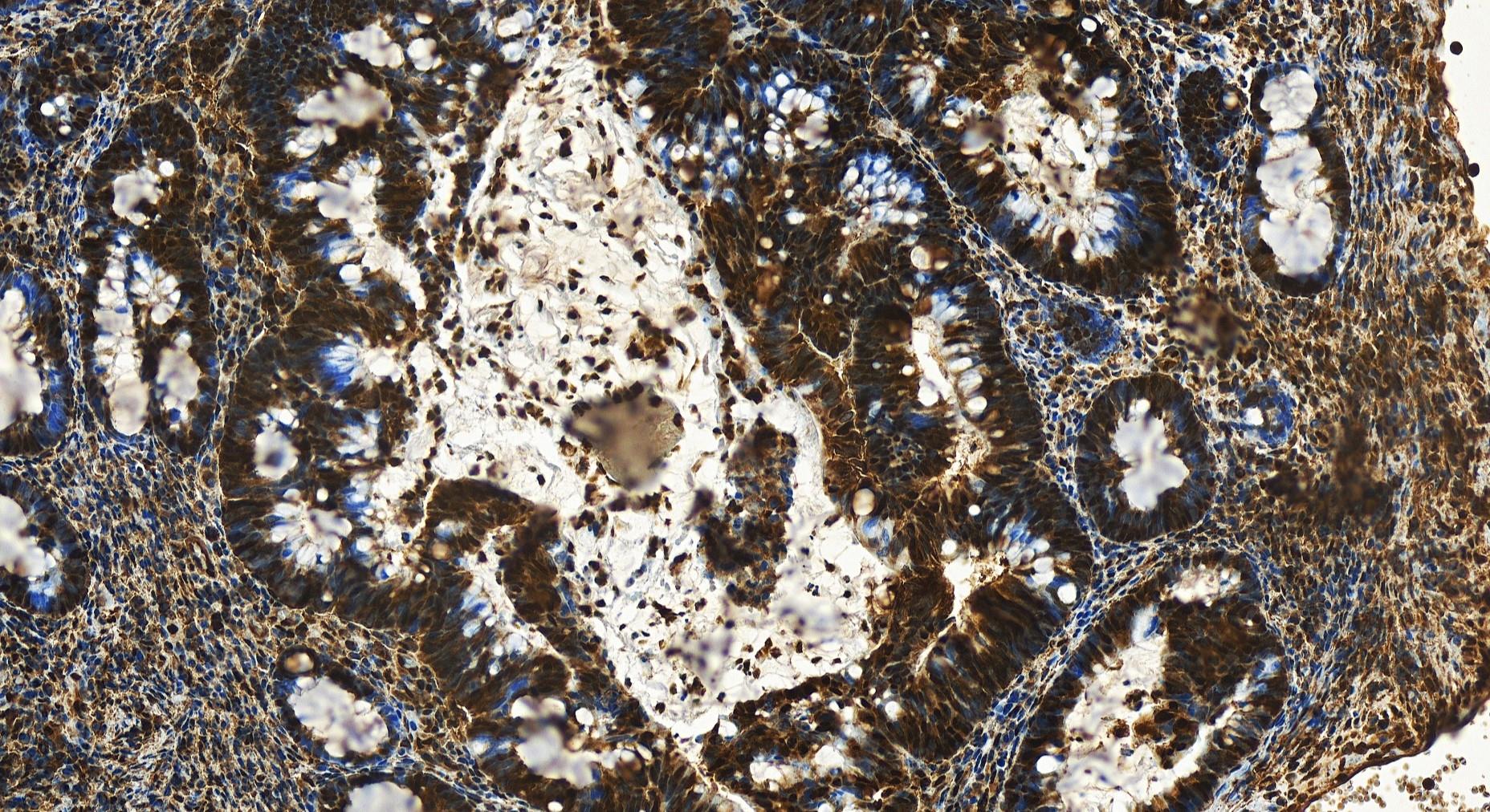 Immunohistochemistry (IHC) staining of human colon  cancer using OGFR Polyclonal antibody (11177-1-AP)