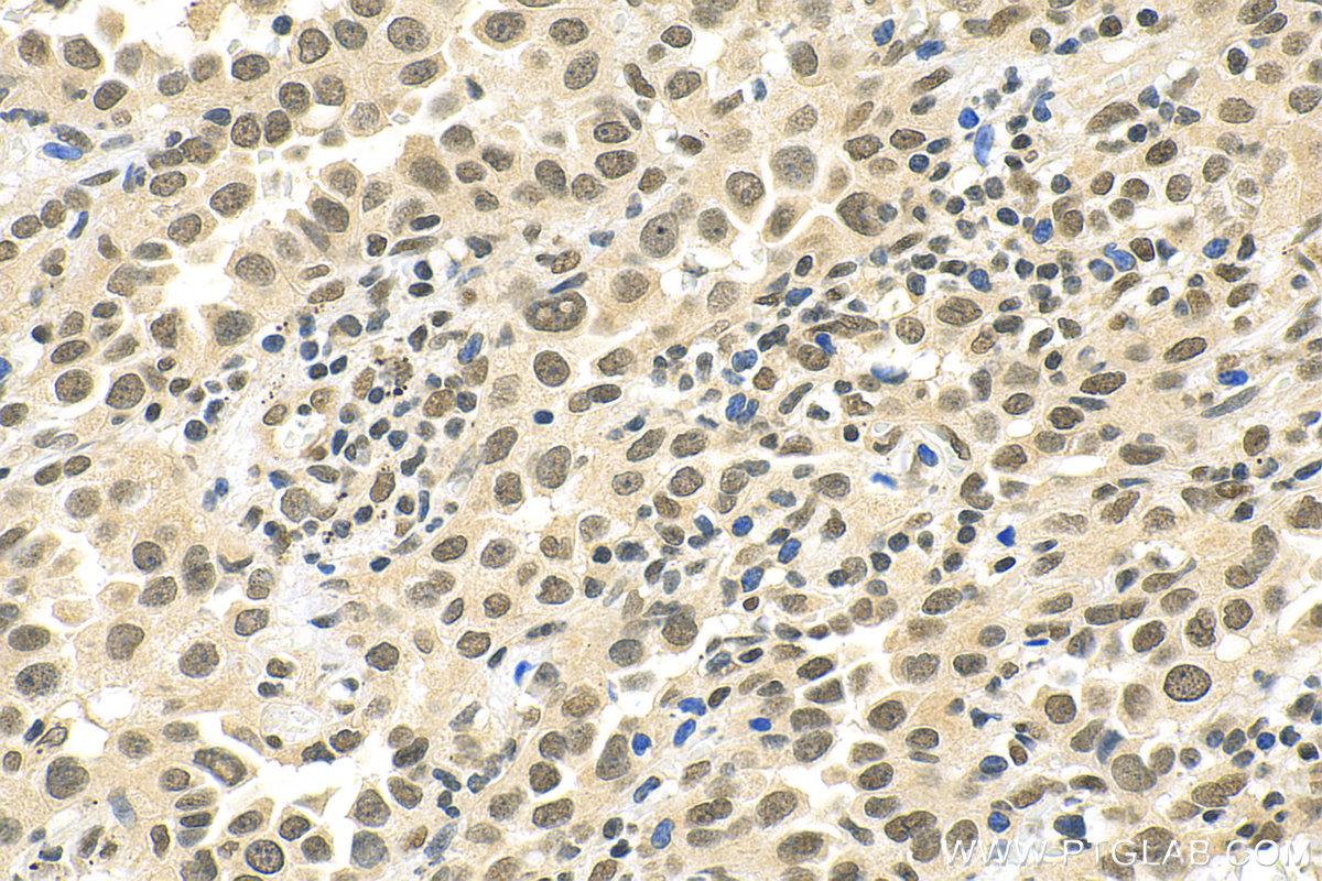 Immunohistochemistry (IHC) staining of human lung cancer tissue using OGT Polyclonal antibody (11576-2-AP)