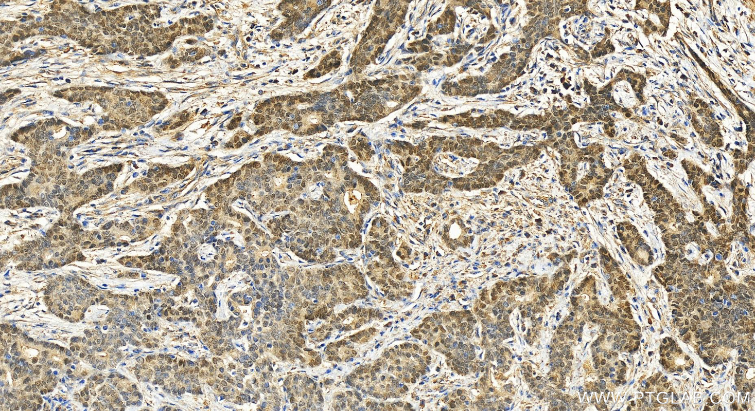 Immunohistochemistry (IHC) staining of human stomach cancer tissue using ONECUT2 Polyclonal antibody (21916-1-AP)