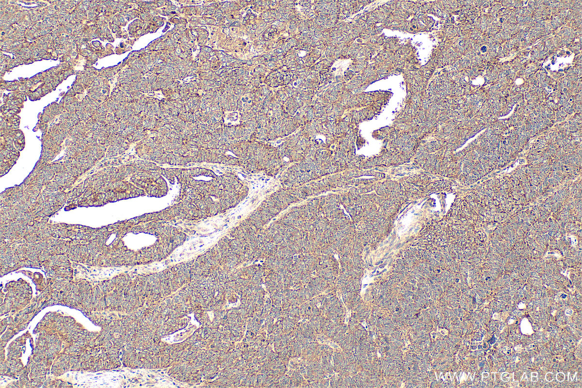 Immunohistochemistry (IHC) staining of human ovary tumor tissue using Osteopontin Polyclonal antibody (22952-1-AP)