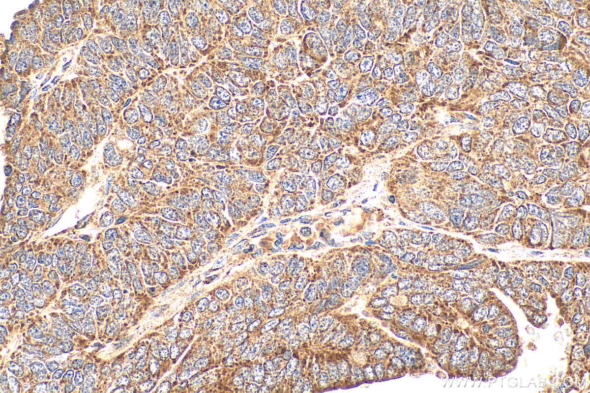Immunohistochemistry (IHC) staining of human ovary tumor tissue using Osteopontin Polyclonal antibody (22952-1-AP)