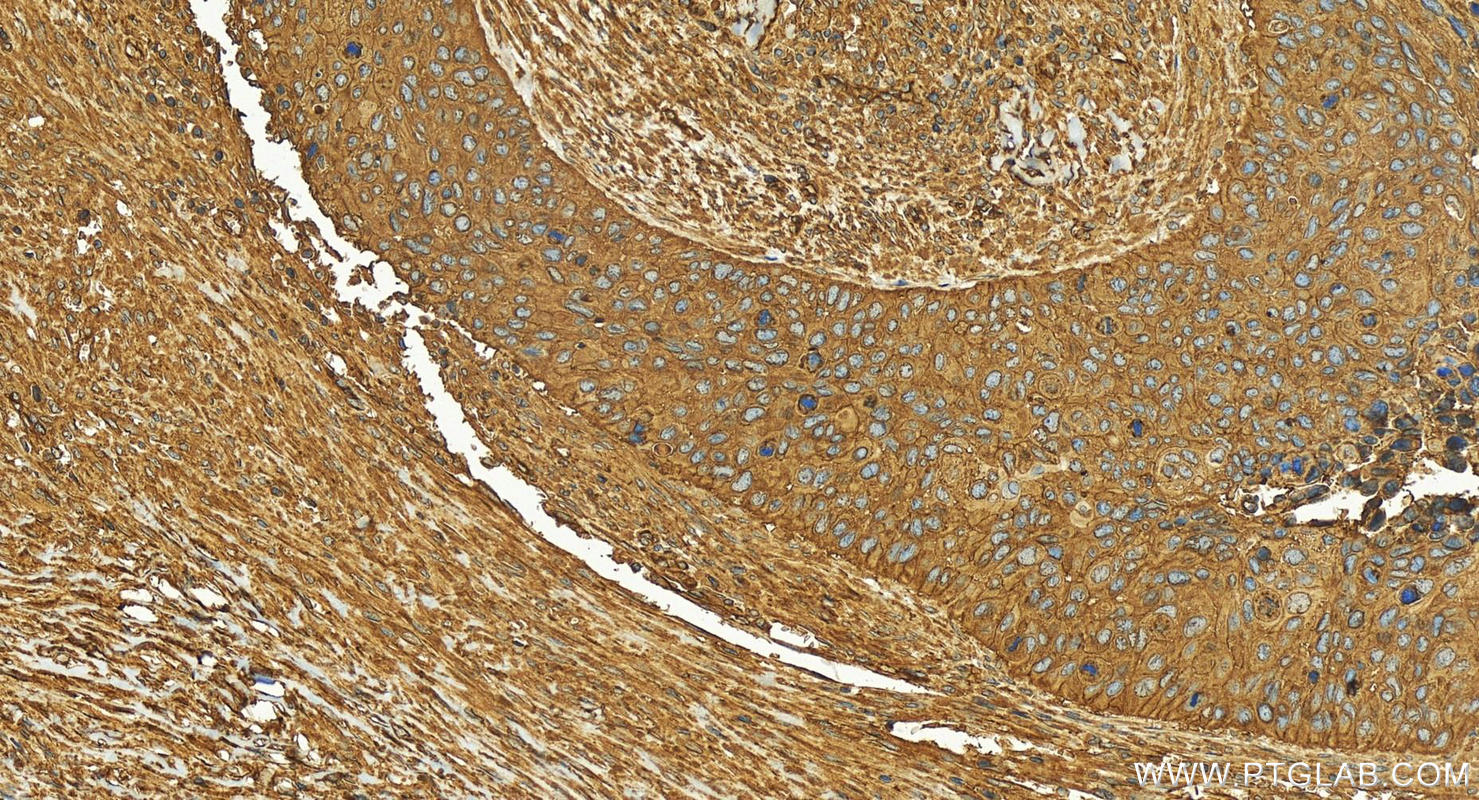 Immunohistochemistry (IHC) staining of human cervical squamous cancer tissue using Osteopontin Recombinant antibody (83341-1-RR)