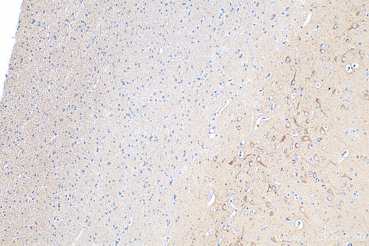 Immunohistochemistry (IHC) staining of human gliomas tissue using OPTN Recombinant antibody (83634-5-RR)