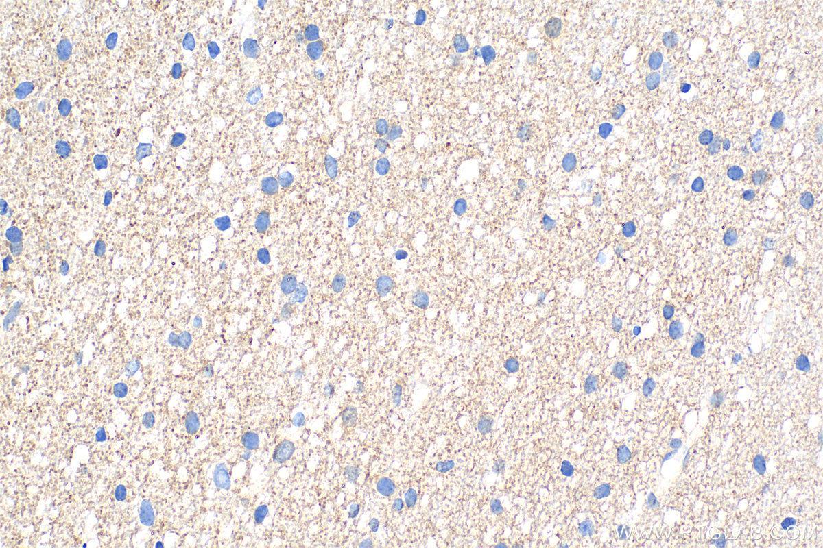 Immunohistochemistry (IHC) staining of human gliomas tissue using OPTN Recombinant antibody (83634-5-RR)