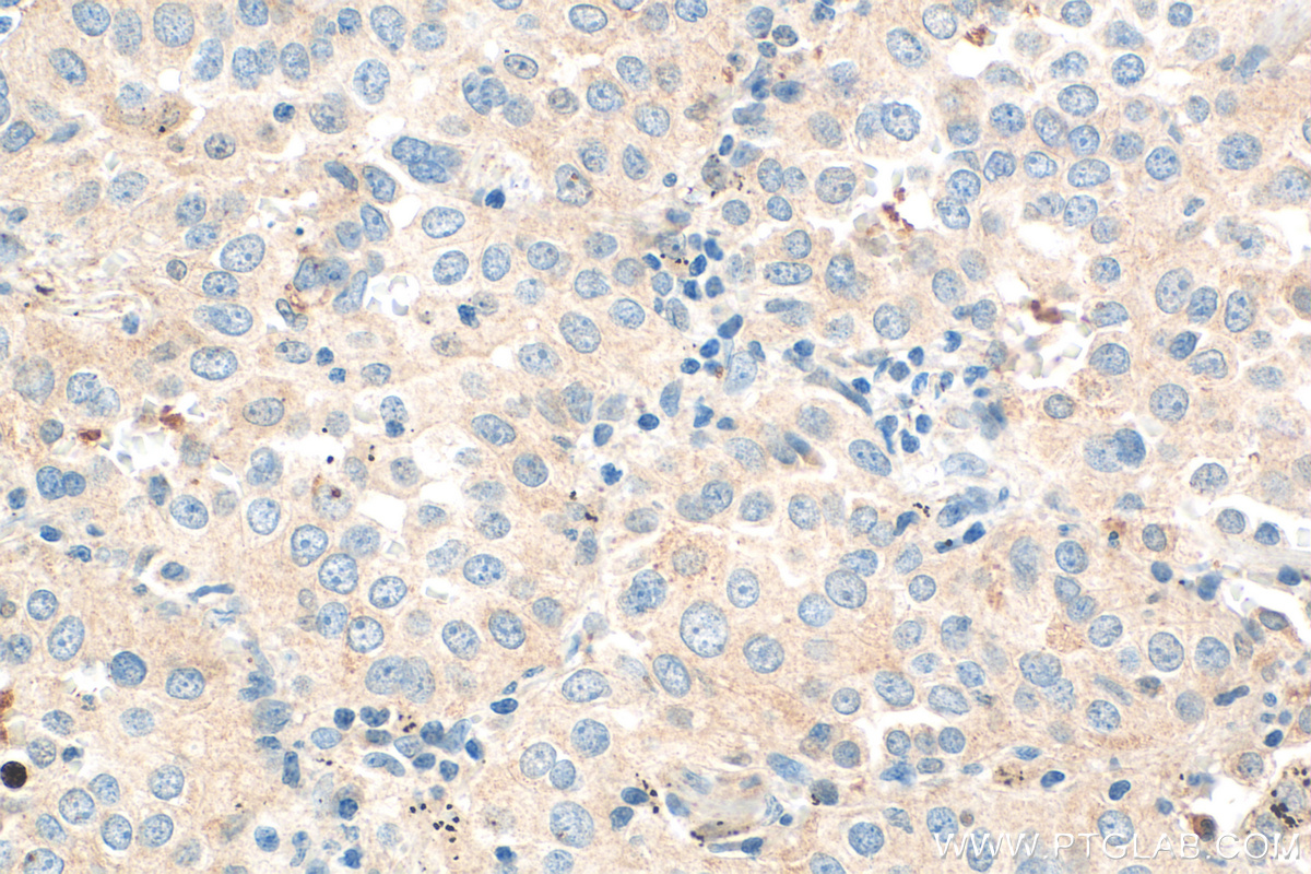 Immunohistochemistry (IHC) staining of human lung cancer tissue using OR2H1 Polyclonal antibody (26954-1-AP)