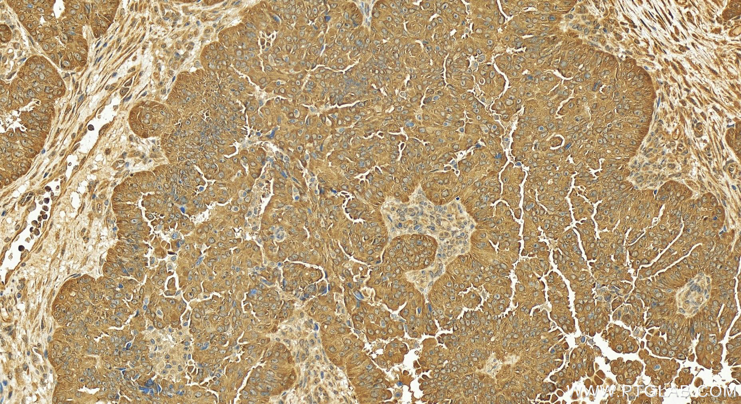 Immunohistochemistry (IHC) staining of human ovary cancer tissue using OSBPL2 Polyclonal antibody (14751-1-AP)