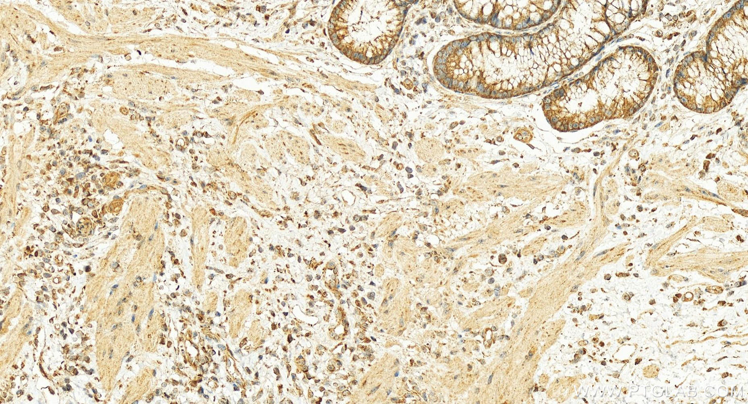 Immunohistochemistry (IHC) staining of human colon cancer tissue using OSBPL3 Polyclonal antibody (12417-1-AP)