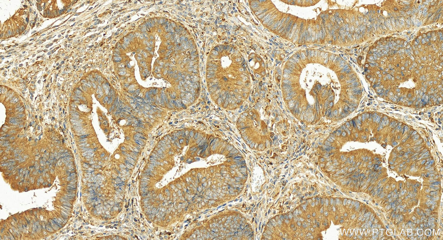 Immunohistochemistry (IHC) staining of human colon cancer tissue using OSBPL3 Polyclonal antibody (12417-1-AP)