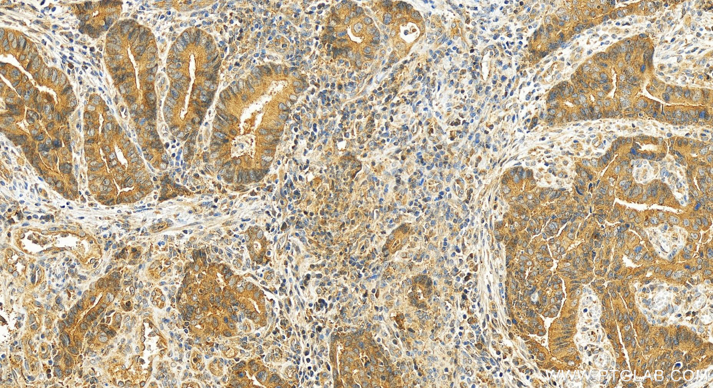 Immunohistochemistry (IHC) staining of human colon cancer tissue using oncostatin M Polyclonal antibody (27792-1-AP)