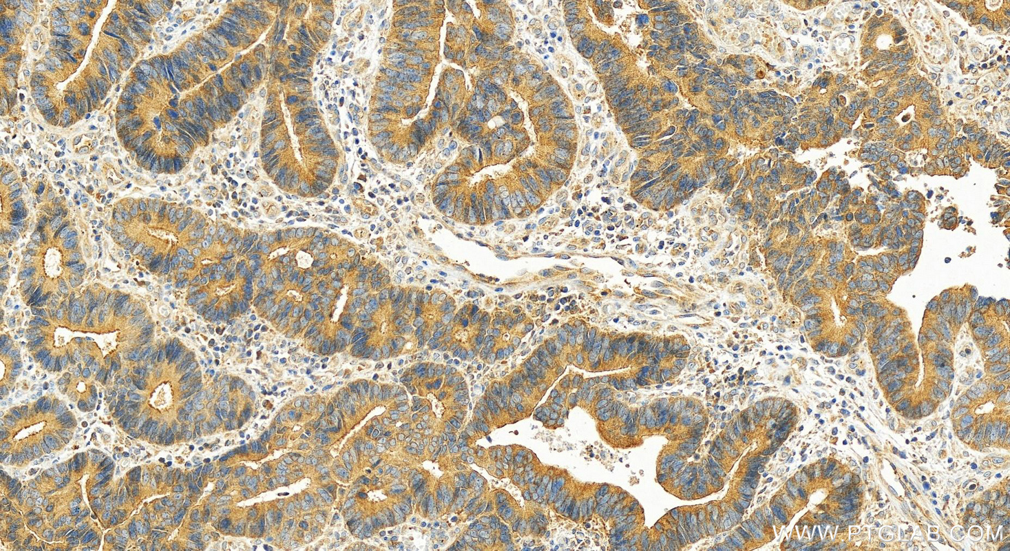 Immunohistochemistry (IHC) staining of human colon cancer tissue using oncostatin M Polyclonal antibody (27792-1-AP)