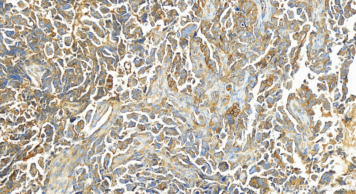 Immunohistochemistry (IHC) staining of human ovary cancer tissue using OTUD6B Polyclonal antibody (25430-1-AP)