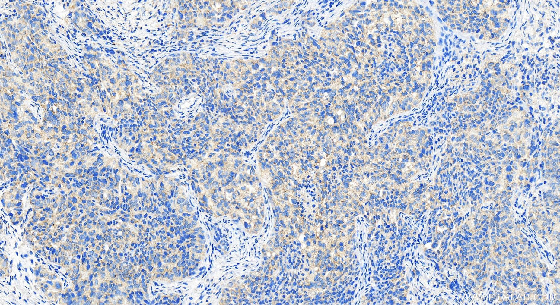 Immunohistochemistry (IHC) staining of human ovary cancer tissue using OVCA1 Polyclonal antibody (20112-1-AP)