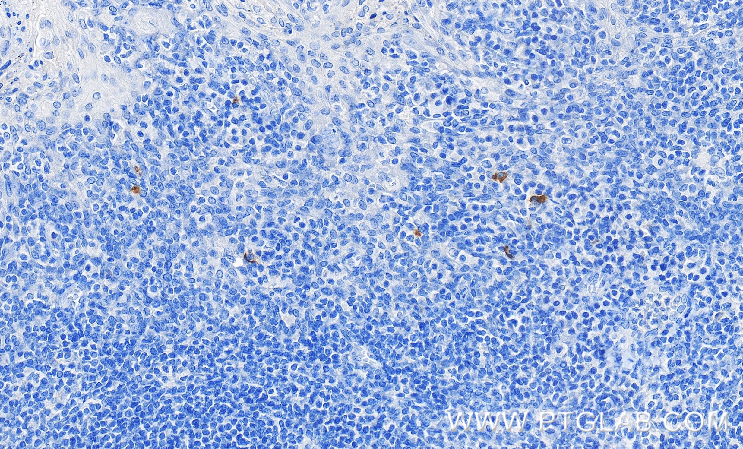 Immunohistochemistry (IHC) staining of human tonsillitis tissue using OX40L/TNFSF4 Recombinant monoclonal antibody (82794-7-RR)