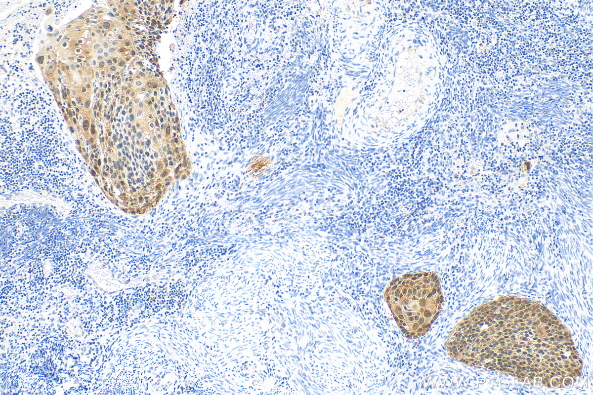 Immunohistochemistry (IHC) staining of human cervical cancer tissue using P16-INK4A Polyclonal antibody (10883-1-AP)