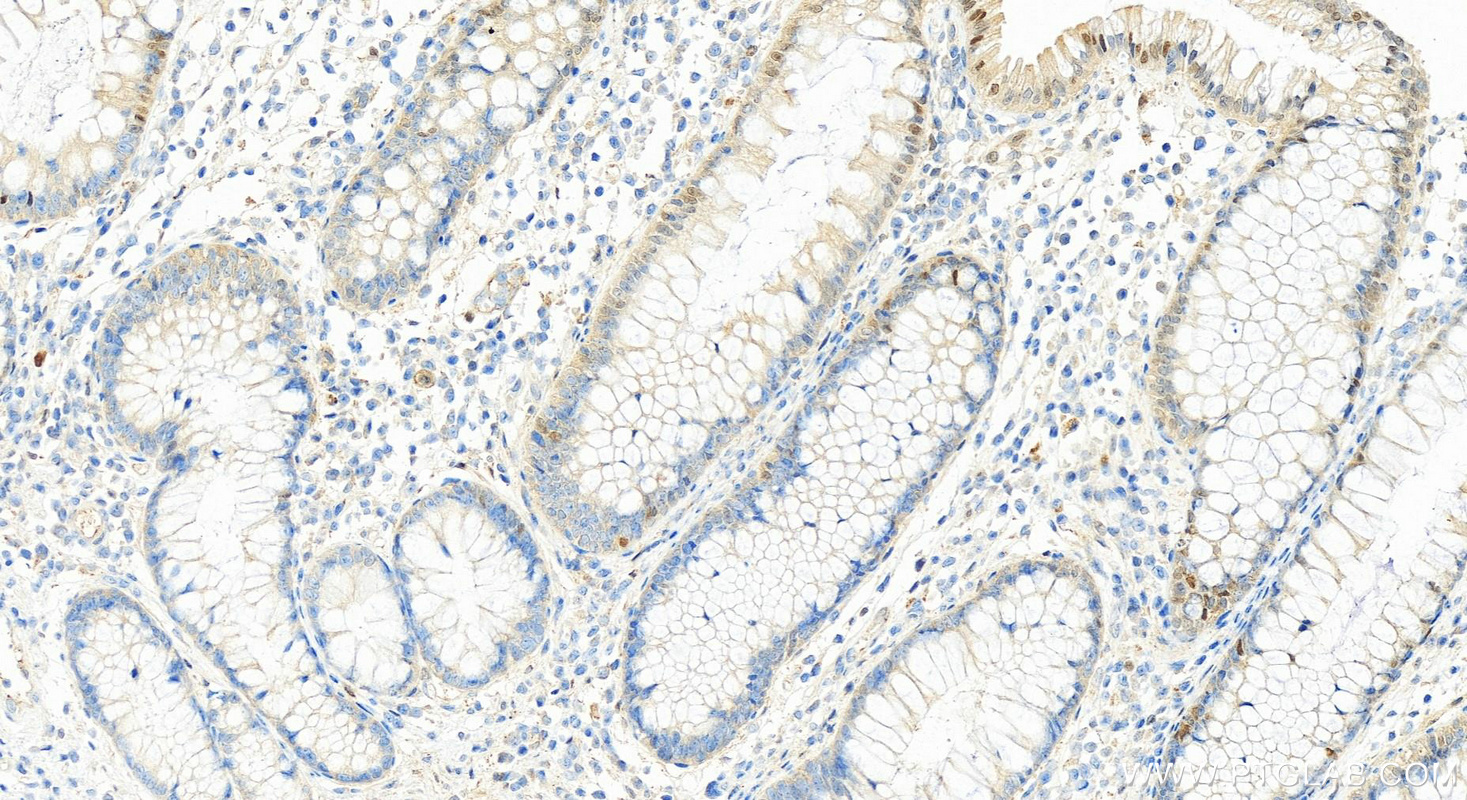 Immunohistochemistry (IHC) staining of human colon cancer tissue using P21 Polyclonal antibody (10355-1-AP)