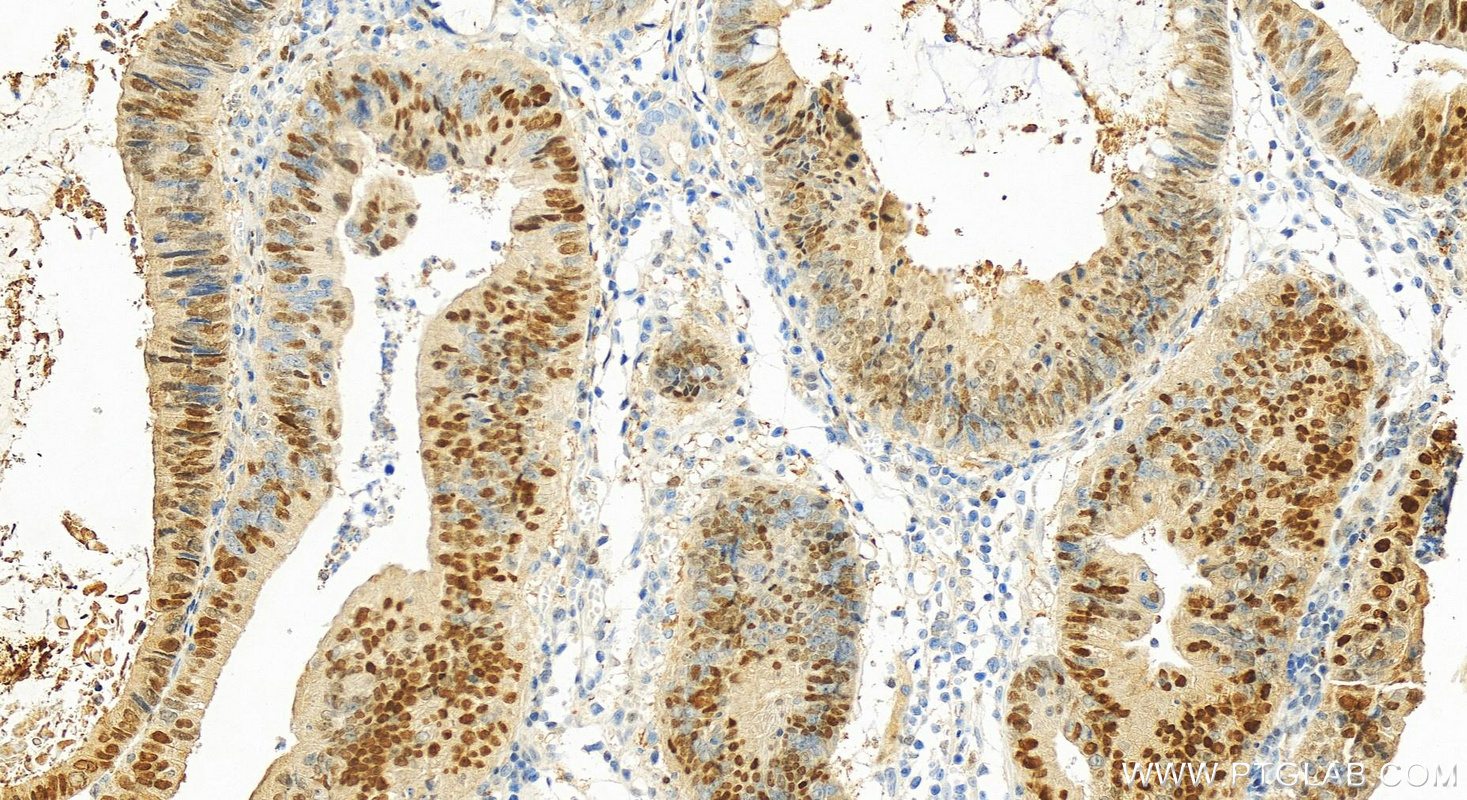 Immunohistochemistry (IHC) staining of human colon cancer tissue using P21 Polyclonal antibody (10355-1-AP)