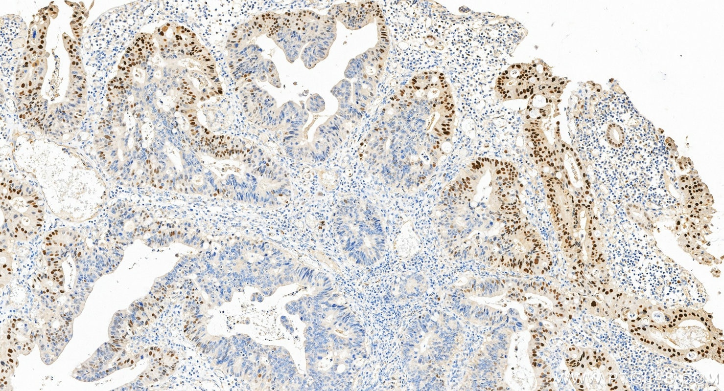 Immunohistochemistry (IHC) staining of human colon cancer tissue using P21 Polyclonal antibody (10355-1-AP)